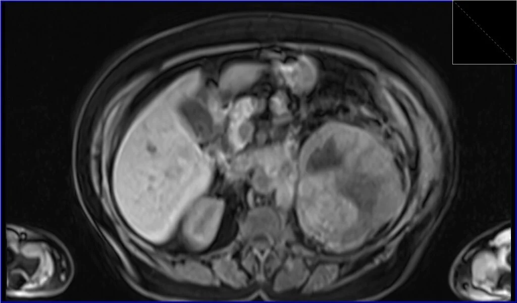 T1 VIBE axial image shows Renal cell carcinoma (RCC)