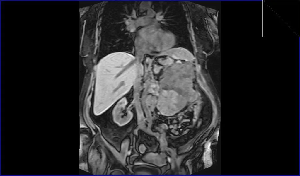 T2 TRUEFISP fat sat coronal image shows Renal cell carcinoma (RCC)