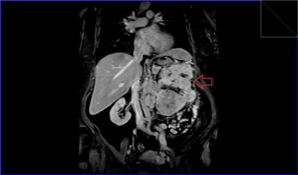T1 VIBE coronal post contrast image shows Renal cell carcinoma (RCC)