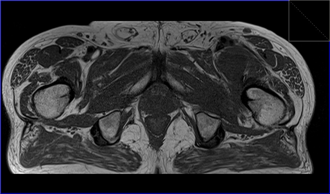 Iliopsoas Bursitis MRI | Iliopectineal bursitis radiology article