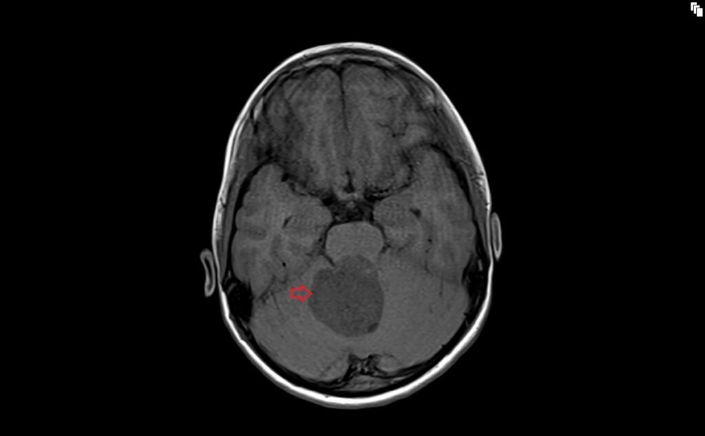 T1 axial image shows Medulloblastoma