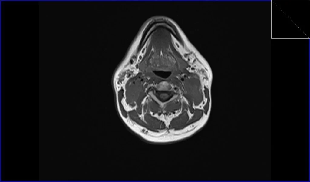 T1 axial image shows neck Lymphoma