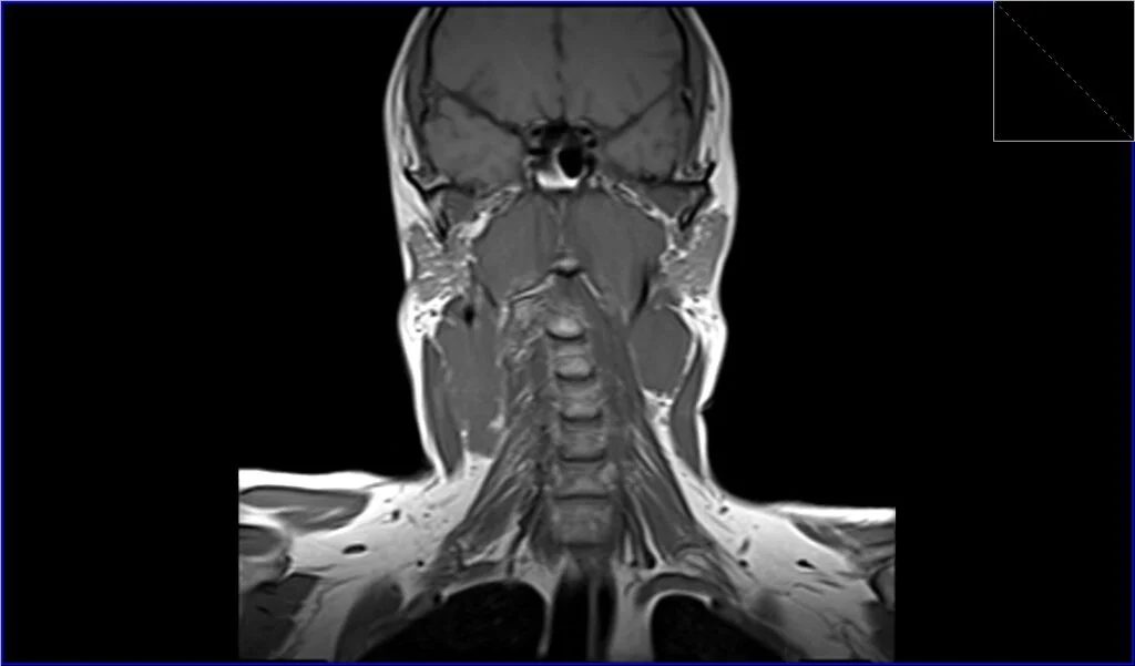 T1 coronal image shows Lymphoma