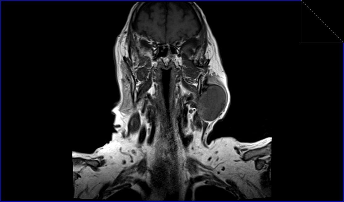 Warthin's tumor MRI