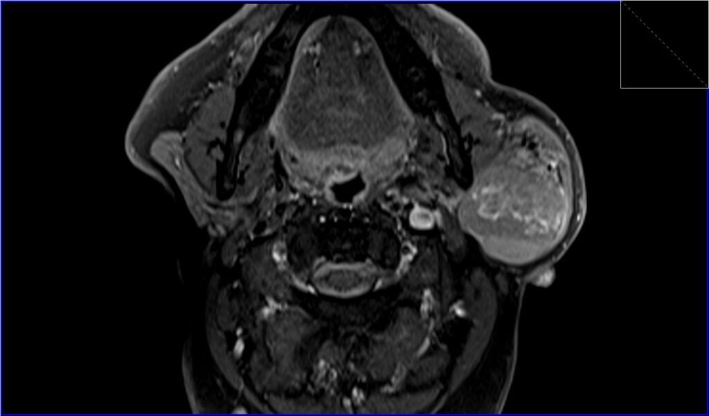 Warthin's tumor MRI