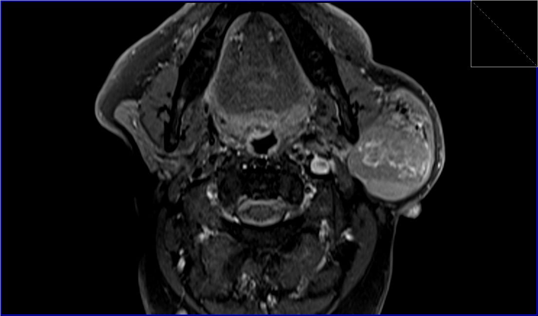 Warthin's Tumor Mri