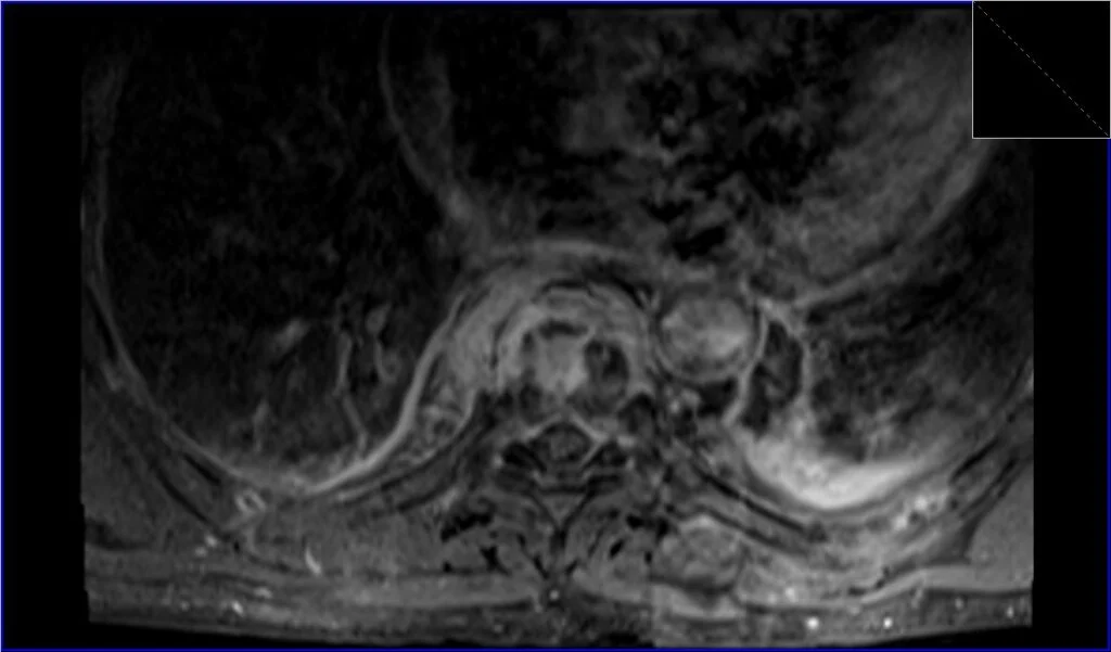 T1 fat sat post contrast axial image shows discitis