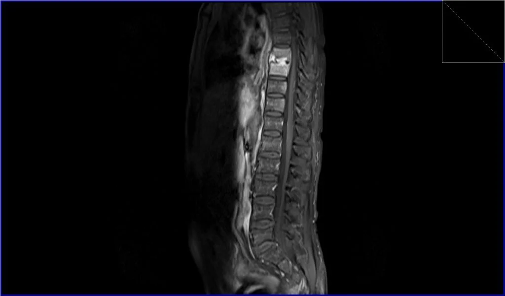 T1 fat sat post contrast sagittal image shows discitis