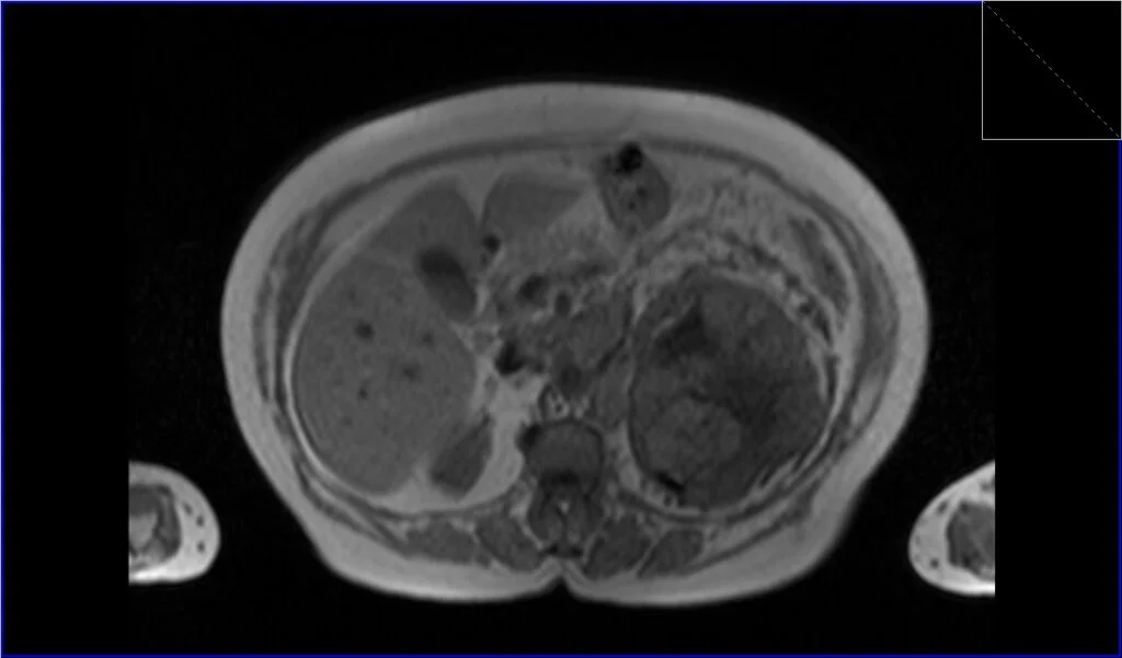 T1 in-phase axial image shows Renal cell carcinoma (RCC)