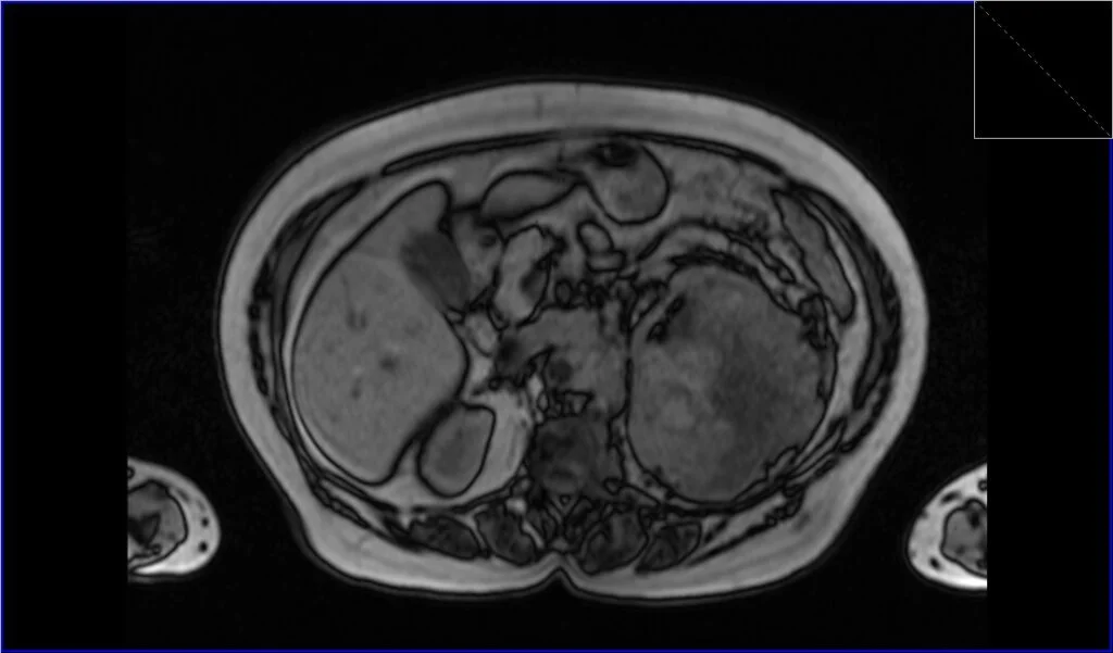 T1 out-of-phase axial image shows Renal cell carcinoma (RCC)
