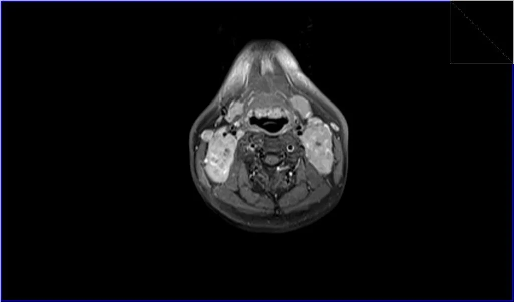 T1 post contrast FS axial image shows neck Lymphoma