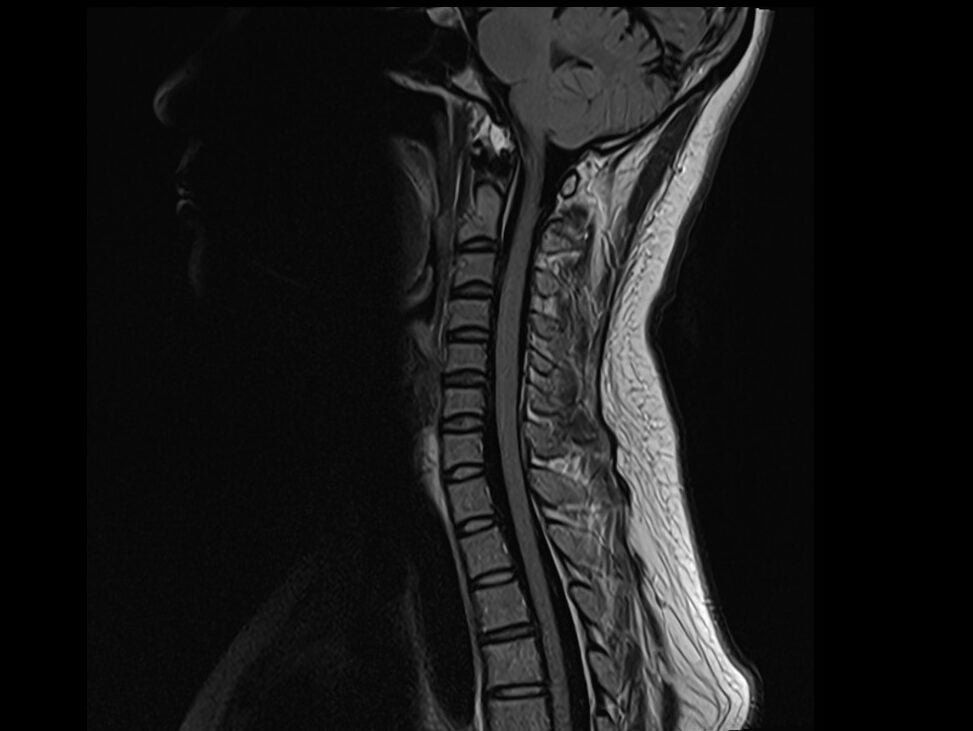 FLAIR MRI FLAIR MRI Sequence Physics Image And Pathology Appearance