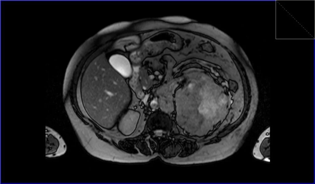 T2 TRUEFISP axial image shows Renal cell carcinoma (RCC)