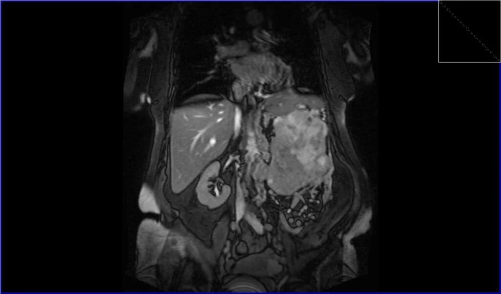 T2 TRUEFISP fat sat coronal image shows Renal cell carcinoma (RCC)