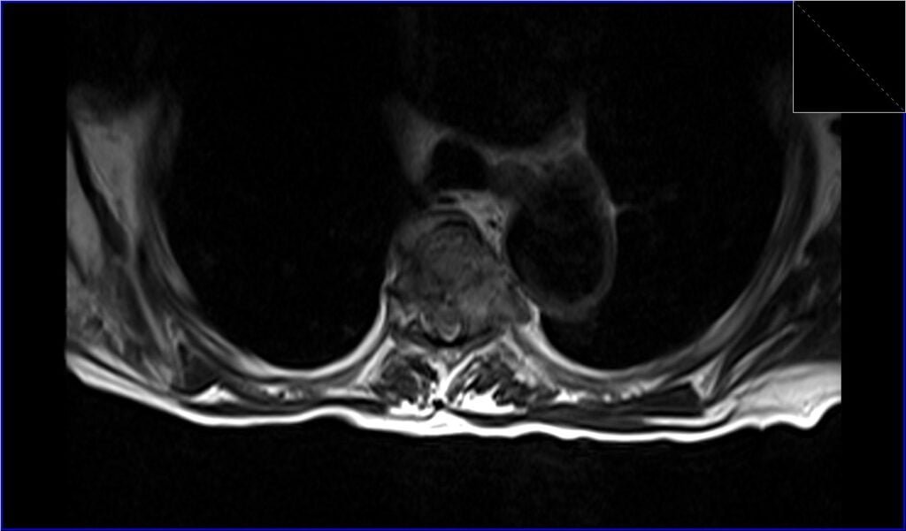 T2 TSE axial image shows Metastatic Spinal Cord Compression