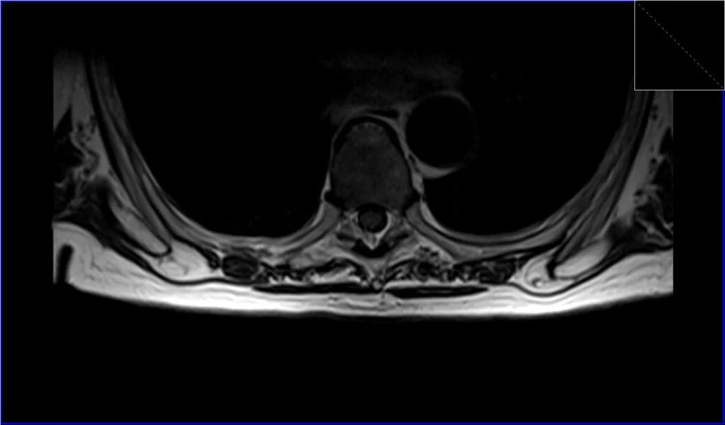 T2 TSE axial image shows Spinal Schwannoma