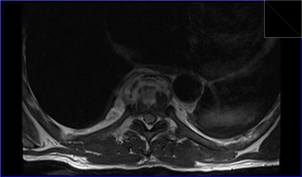 T2 TSE axial image shows discitis