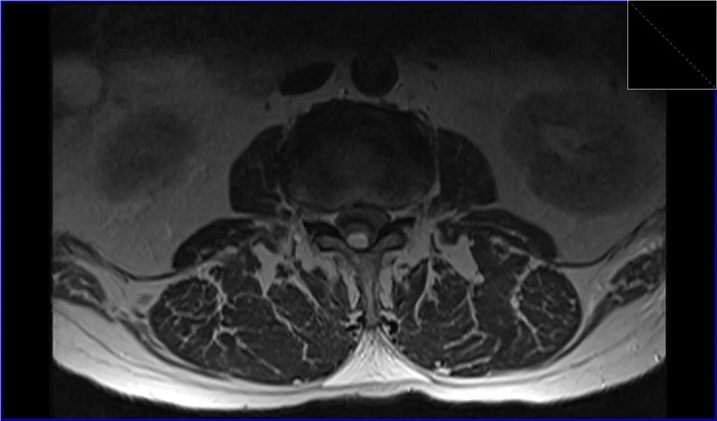 T2 TSE axial image shows seroma