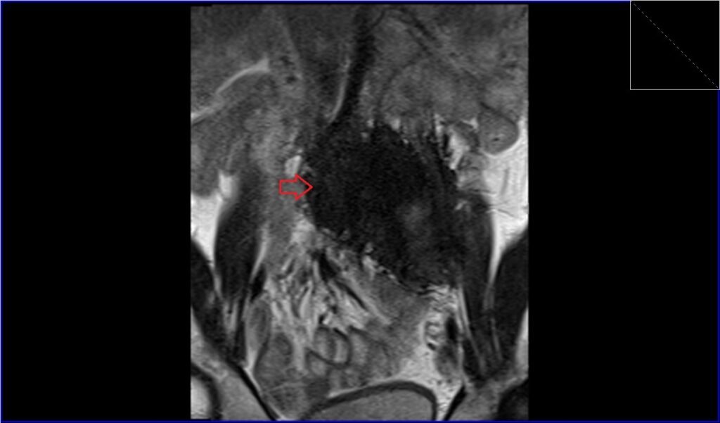 T2 TSE coronal image shows retroperitoneal desmoid