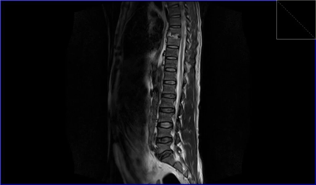 T2 TSE sagittal image shows discitis