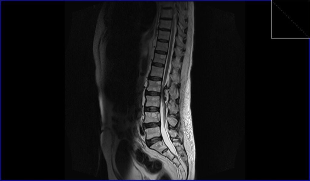 T2 TSE sagittal image shows seroma