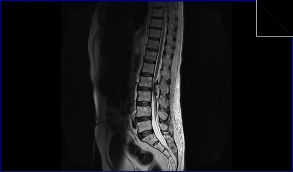 T2 TSE sagittal image shows seroma