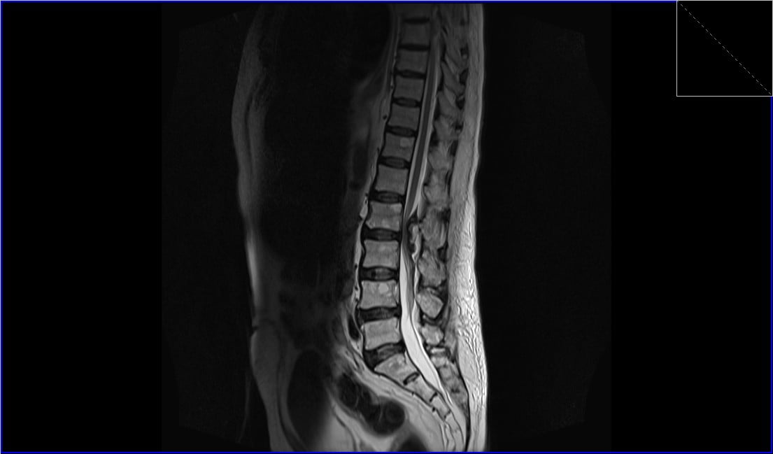 Spinal Seroma MRI | Radiology article on how to report Seroma