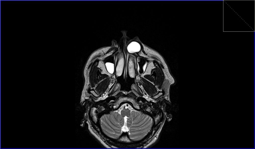 Epidermoid Cyst Mri Radiology Article On Mri Of Epidermoid Cysts 0580