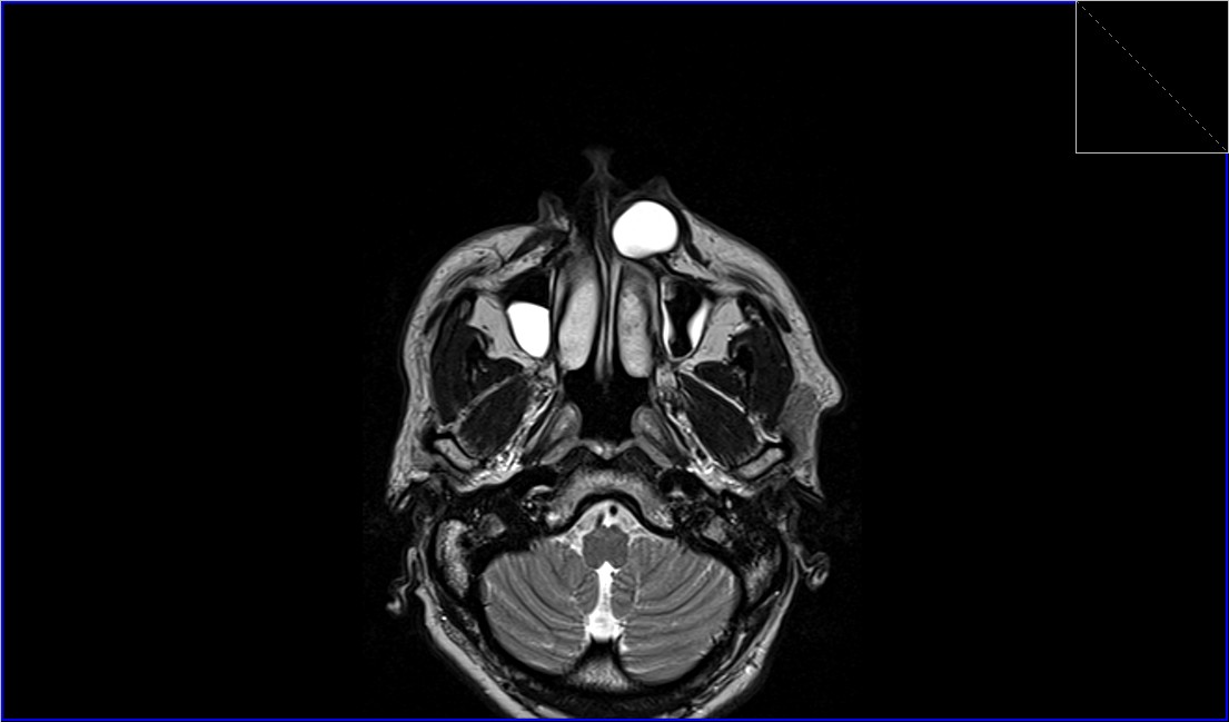 Epidermoid Cyst Mri Radiology Article On Mri Of Epidermoid Cysts 2905