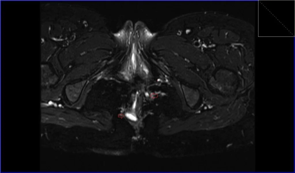 T2 fat saturated axial oblique image shows Anorectal Fistula