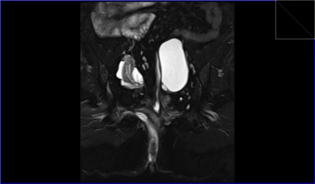 T2 fat saturated coronal oblique image shows Anorectal Fistula