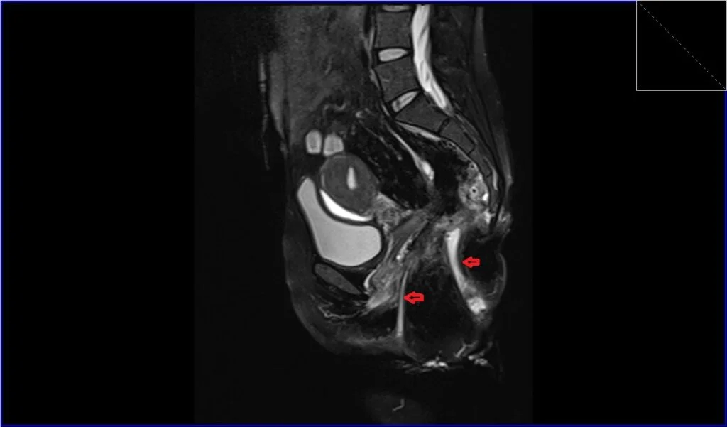 T2 fat saturated sagittal image shows Anorectal Fistula