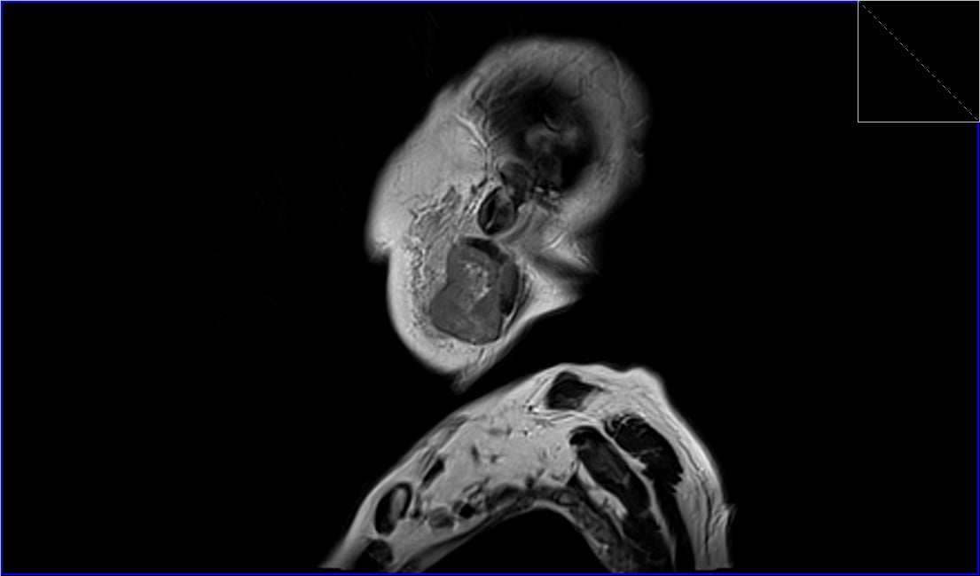 Warthin's tumor MRI