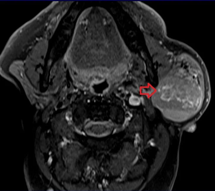 Warthin's tumor MRI