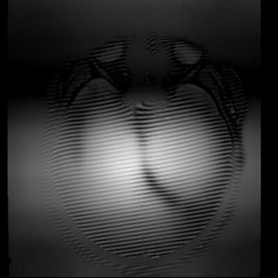 Zebra Artifact or Zebra Stripes artifact MRI Zebra Artifact or Zebra Stripes artifact MRI