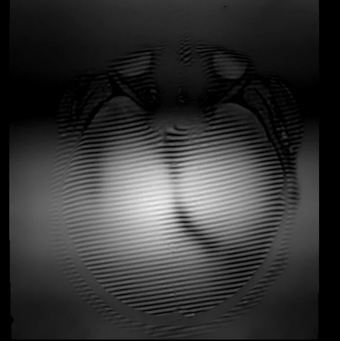 Zebra Artifact or Zebra Stripes artifact MRI