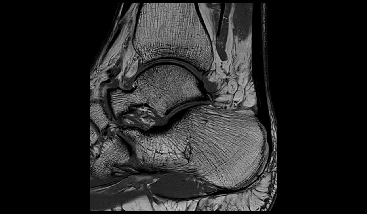 Ankle MRI sagittal t1 image