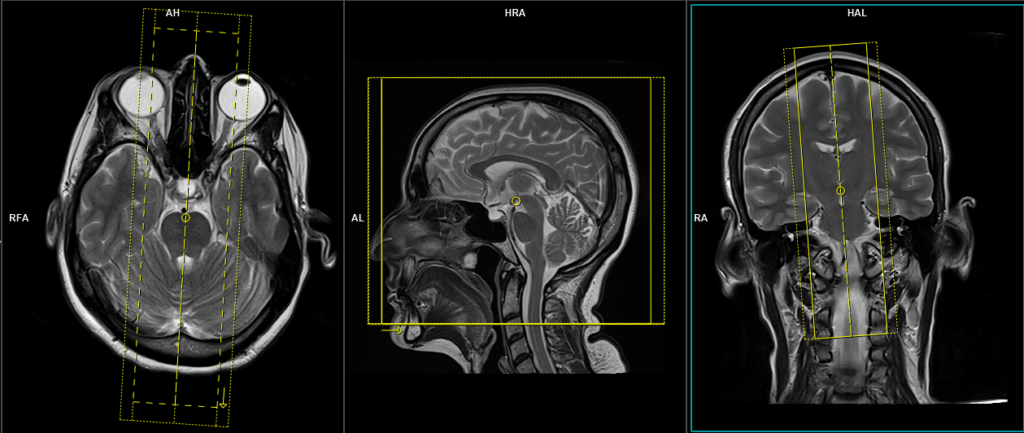 Cerebrospinal fluid flow MRI | CSF flow MRI protocol and planning