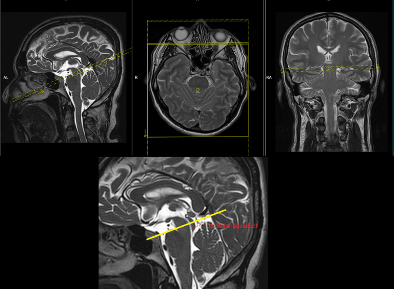 Cerebrospinal fluid flow MRI | CSF flow MRI protocol and planning