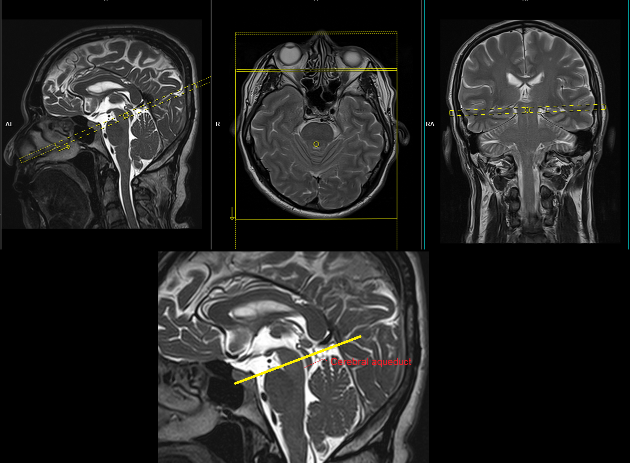 Cerebrospinal fluid flow MRI | CSF flow MRI protocol and planning