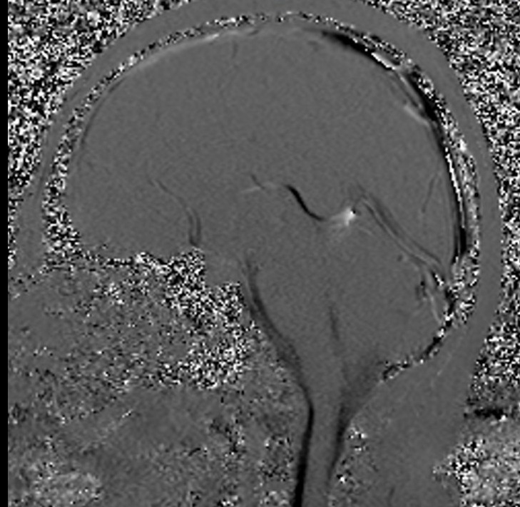 Cerebrospinal fluid flow MRI | CSF flow MRI protocol and planning