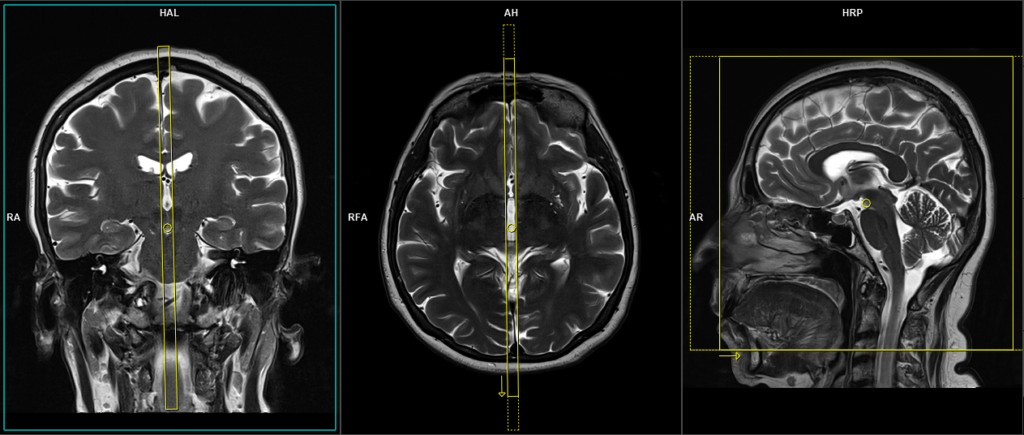 MRI CSF flow in- plane scan protocol and planning