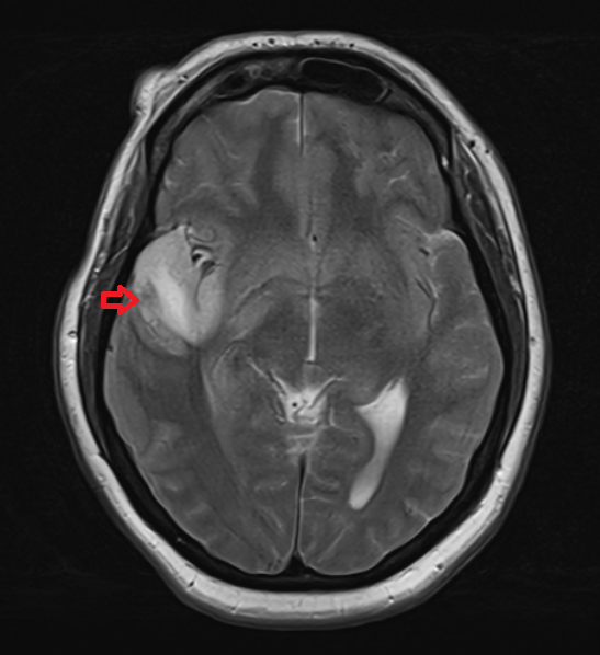 MRI Encephalitis | Radiology article on herpes simplex encephalitis