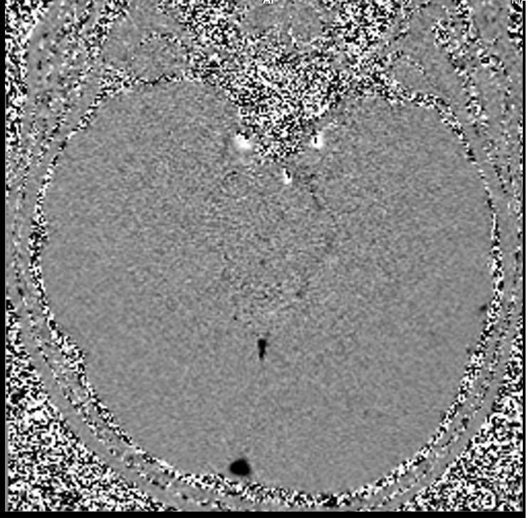 Phase contrast fow MRI | Phase contrast CSF and blood MRI physics and ...