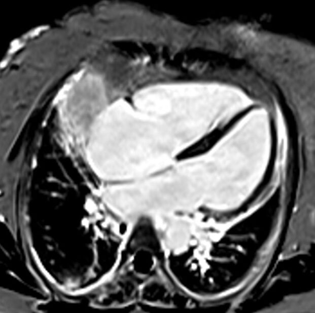 Phase-sensitive inversion recovery (PSIR) MRI | PSIR Cardiac MRI