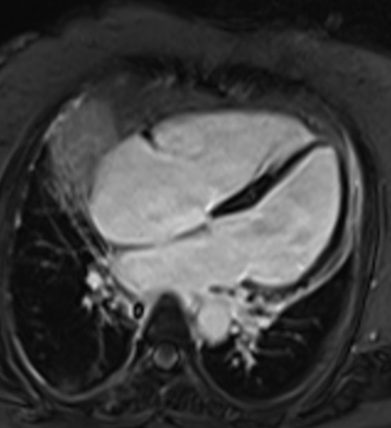 Phase-sensitive inversion recovery (PSIR) MRI | PSIR Cardiac MRI