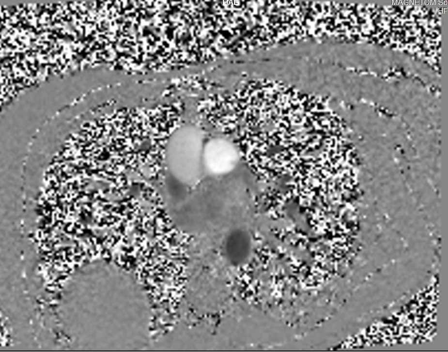 Phase contrast fow MRI | Phase contrast CSF and blood MRI physics and ...