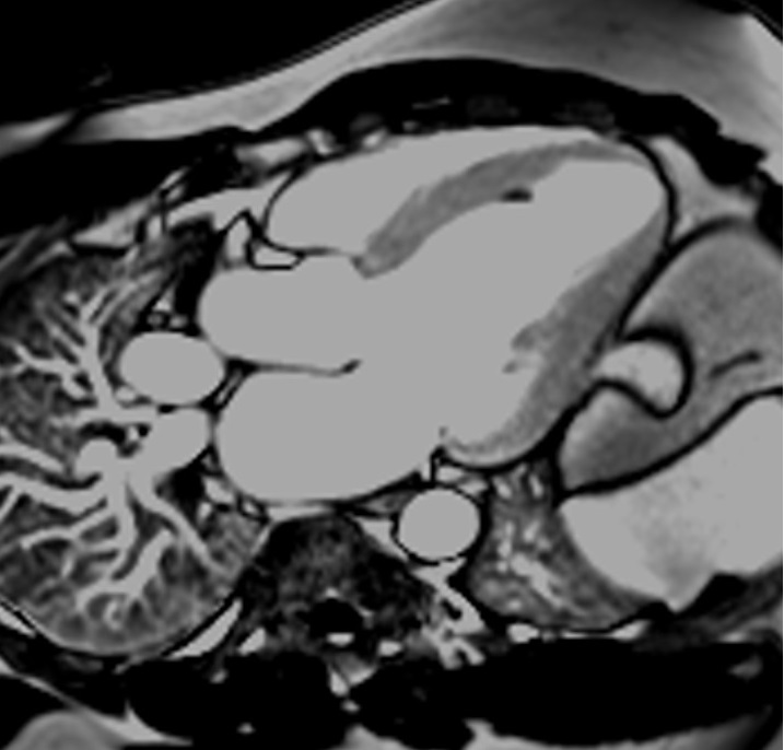 Phase-sensitive inversion recovery (PSIR) MRI | PSIR Cardiac MRI