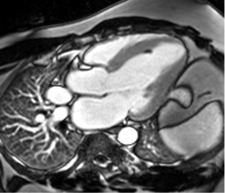 Phase-sensitive inversion recovery (PSIR) MRI | PSIR Cardiac MRI