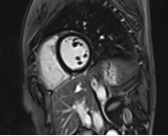 Phase-sensitive inversion recovery (PSIR) MRI | PSIR Cardiac MRI